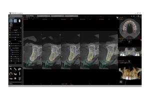 cs-solutions-for-implants